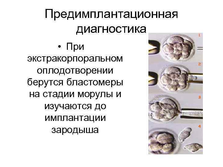 Предимплантационная диагностика • При экстракорпоральном оплодотворении берутся бластомеры на стадии морулы и изучаются до