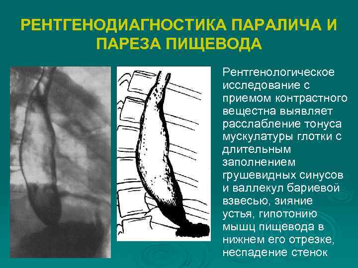 РЕНТГЕНОДИАГНОСТИКА ПАРАЛИЧА И ПАРЕЗА ПИЩЕВОДА Рентгенологическое исследование с приемом контрастного вещестна выявляет расслабление тонуса