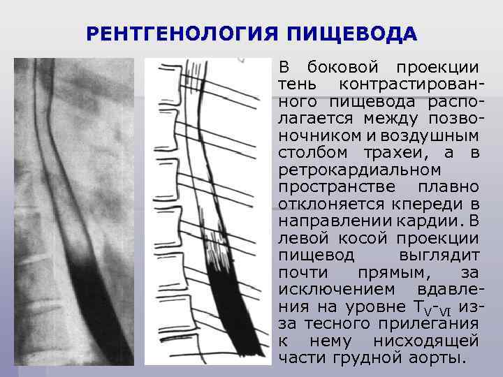 РЕНТГЕНОЛОГИЯ ПИЩЕВОДА В боковой проекции тень контрастированного пищевода располагается между позвоночником и воздушным столбом