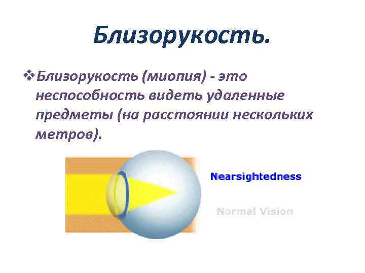 Близорукость. v. Близорукость (миопия) - это неспособность видеть удаленные предметы (на расстоянии нескольких метров).