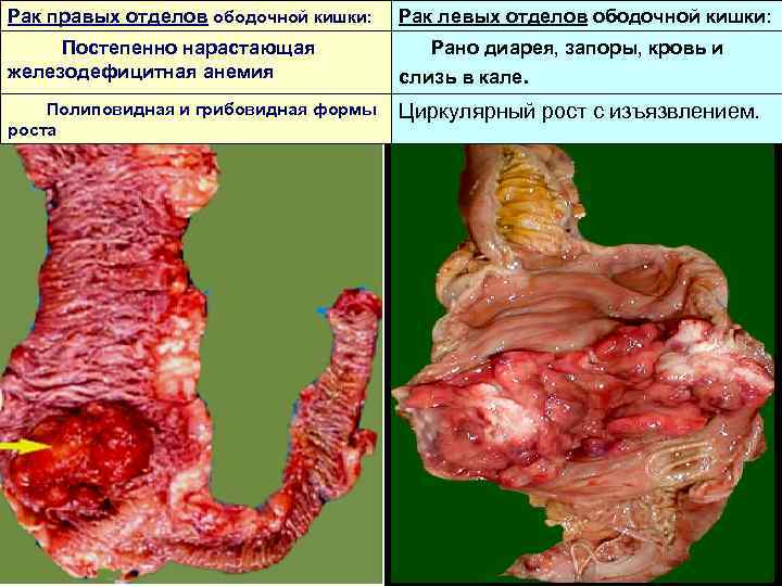 Рак правых отделов ободочной кишки: Постепенно нарастающая железодефицитная анемия Полиповидная и грибовидная формы роста