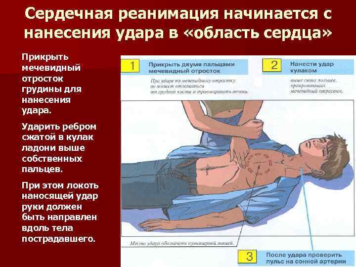Сердечная реанимация начинается с нанесения удара в «область сердца» Прикрыть мечевидный отросток грудины для