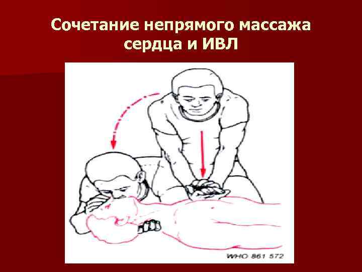 Сочетание непрямого массажа сердца и ИВЛ 