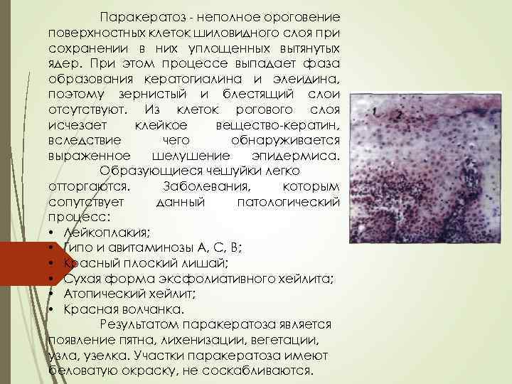 Паракератоз - неполное ороговение поверхностных клеток шиловидного слоя при сохранении в них уплощенных вытянутых
