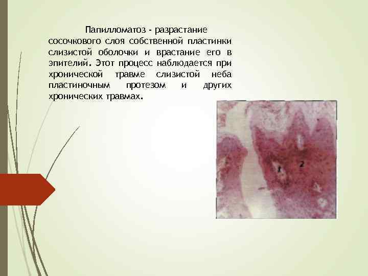 Папилломатоз - разрастание сосочкового слоя собственной пластинки слизистой оболочки и врастание его в эпителий.