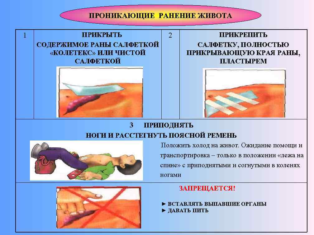 ПРОНИКАЮЩИЕ РАНЕНИЕ ЖИВОТА 1 ПРИКРЫТЬ СОДЕРЖИМОЕ РАНЫ САЛФЕТКОЙ «КОЛЕТЕКС» ИЛИ ЧИСТОЙ САЛФЕТКОЙ 2 ПРИКРЕПИТЬ