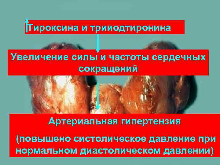 Тироксина и трииодтиронина Увеличение силы и частоты сердечных сокращений Артериальная гипертензия (повышено систолическое давление