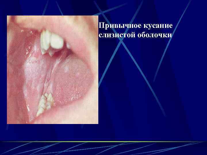 Привычное кусание слизистой оболочки 