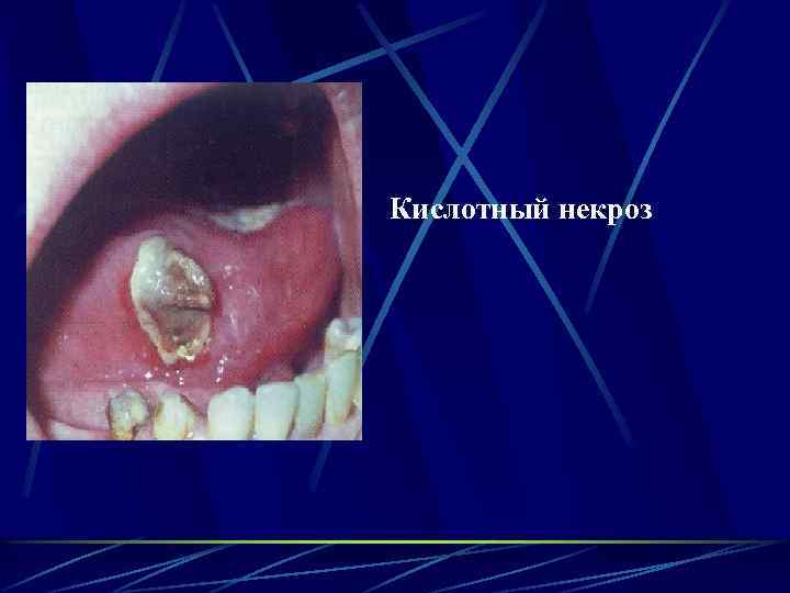 Кислотный некроз 