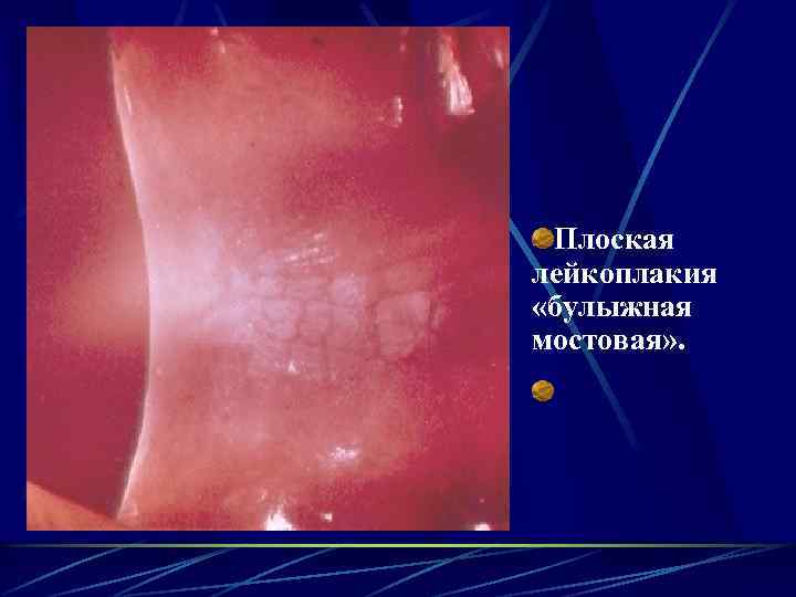 Плоская лейкоплакия «булыжная мостовая» . 