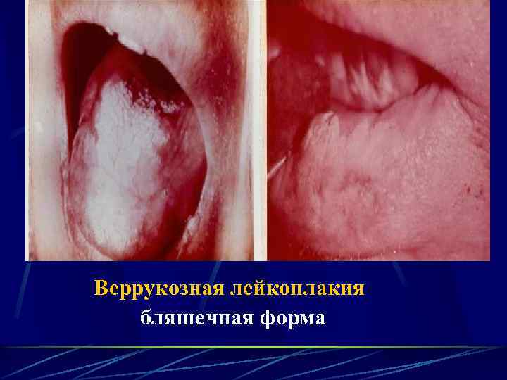 Веррукозная лейкоплакия бляшечная форма 