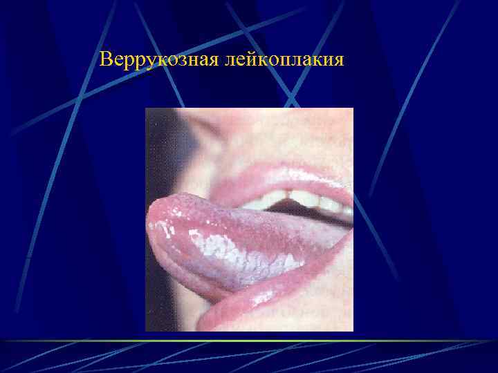  Веррукозная лейкоплакия 