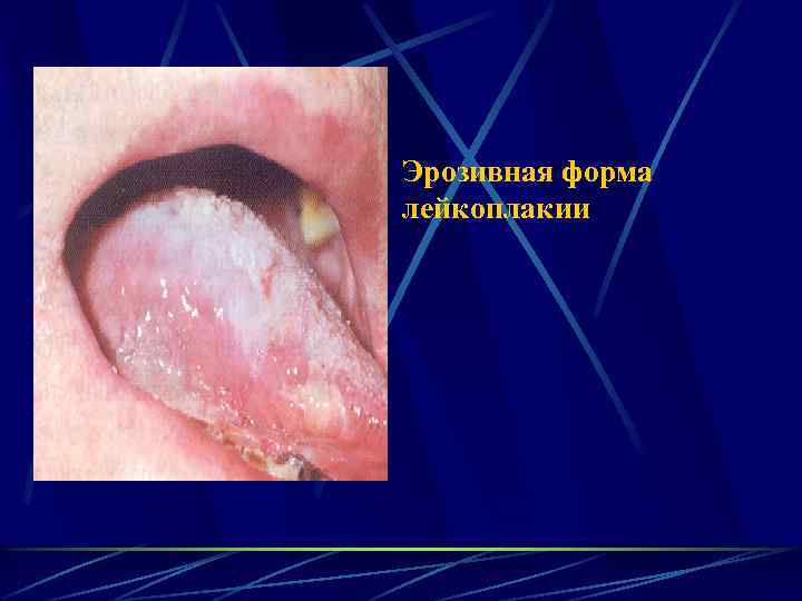 Эрозивная форма лейкоплакии 