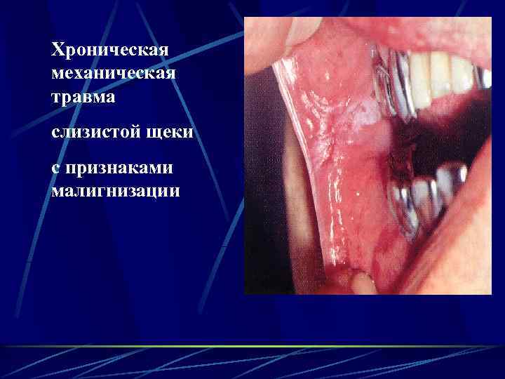 Хроническая механическая травма слизистой щеки с признаками малигнизации 