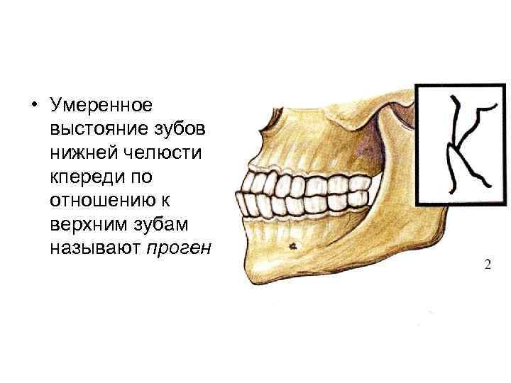 Прогения нижней челюсти