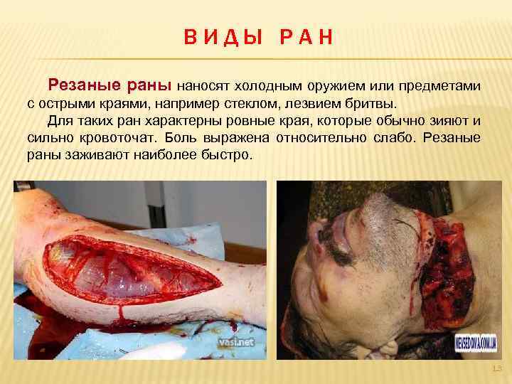 ВИДЫ РАН Резаные раны наносят холодным оружием или предметами с острыми краями, например стеклом,