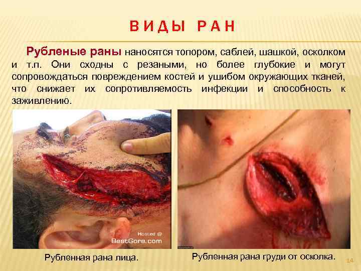 ВИДЫ РАН Рубленые раны наносятся топором, саблей, шашкой, осколком и т. п. Они сходны