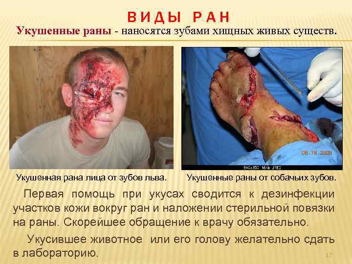 ВИДЫ РАН Укушенные раны - наносятся зубами хищных живых существ. Укушенная рана лица от