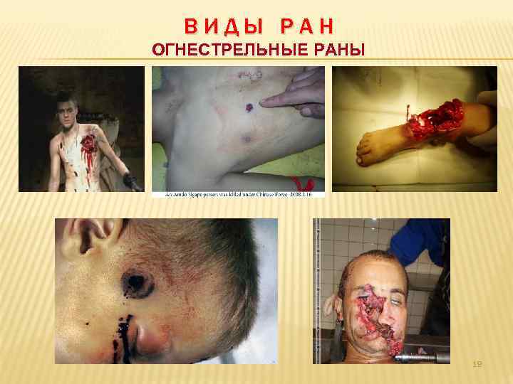 ВИДЫ РАН ОГНЕСТРЕЛЬНЫЕ РАНЫ 19 
