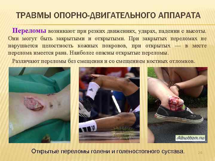 ТРАВМЫ ОПОРНО-ДВИГАТЕЛЬНОГО АППАРАТА Переломы возникают при резких движениях, ударах, падении с высоты. Они могут
