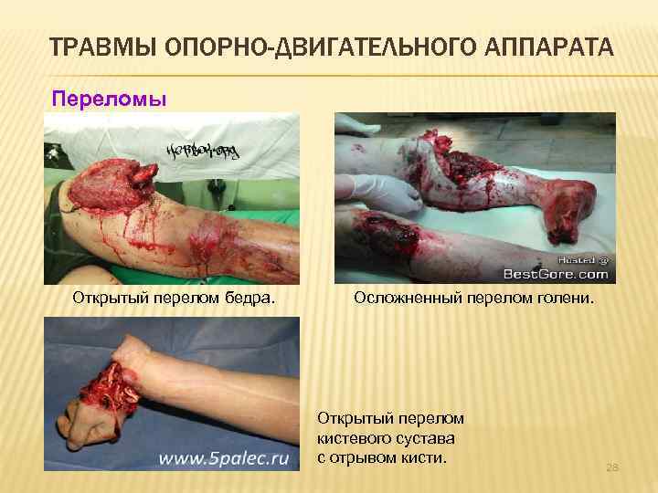 ТРАВМЫ ОПОРНО-ДВИГАТЕЛЬНОГО АППАРАТА Переломы Открытый перелом бедра. Осложненный перелом голени. Открытый перелом кистевого сустава
