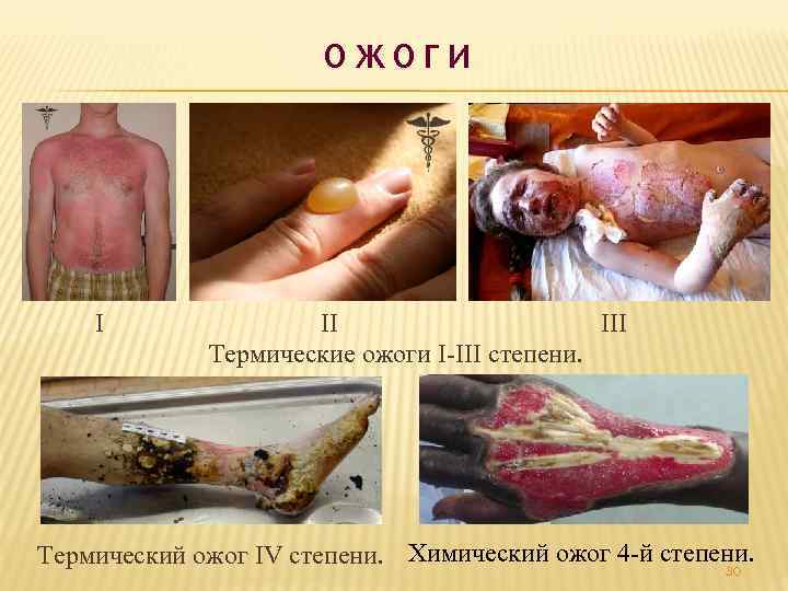 ОЖОГИ I III Термические ожоги I III степени. Термический ожог IV степени. Химический ожог