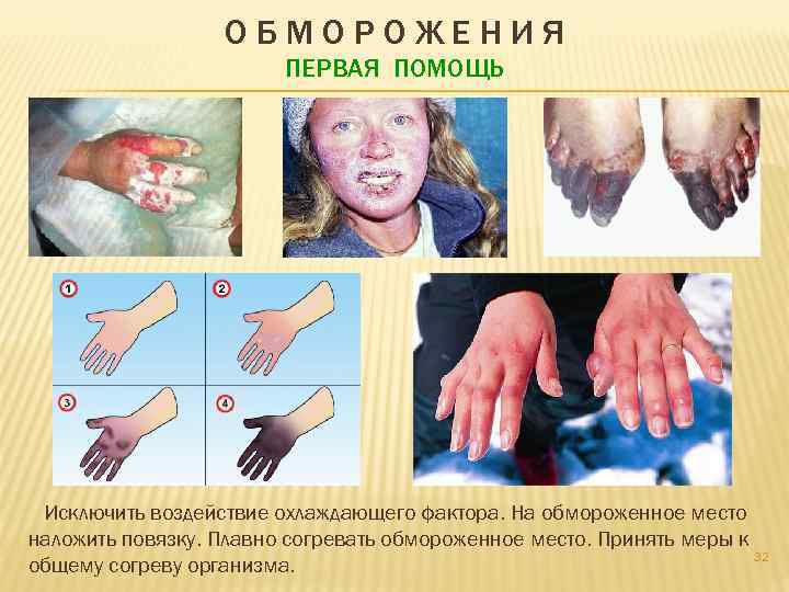 ОБМОРОЖЕНИЯ ПЕРВАЯ ПОМОЩЬ Исключить воздействие охлаждающего фактора. На обмороженное место наложить повязку. Плавно согревать