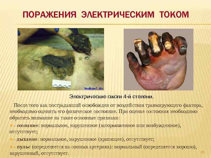 ПОРАЖЕНИЯ ЭЛЕКТРИЧЕСКИМ ТОКОМ Электрические ожоги 4 -й степени. После того как пострадавший освобожден от