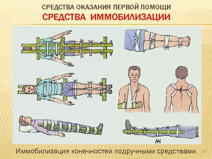 Физическая иммобилизация. Иммобилизация конечности. Средства оказания первой помощи. Подручные средства оказания первой. Подручные средства оказания первой медицинской помощи.