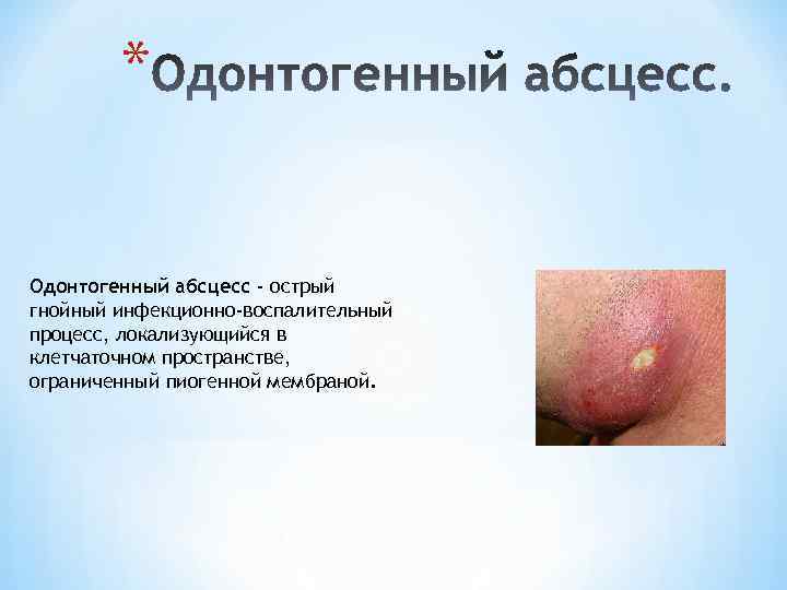 * Одонтогенный абсцесс - острый гнойный инфекционно-воспалительный процесс, локализующийся в клетчаточном пространстве, ограниченный пиогенной