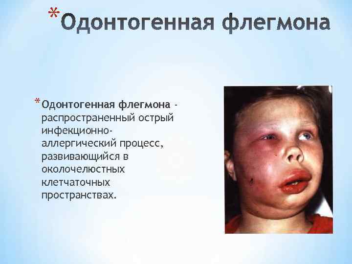 * *Одонтогенная флегмона распространенный острый инфекционноаллергический процесс, развивающийся в околочелюстных клетчаточных пространствах. 