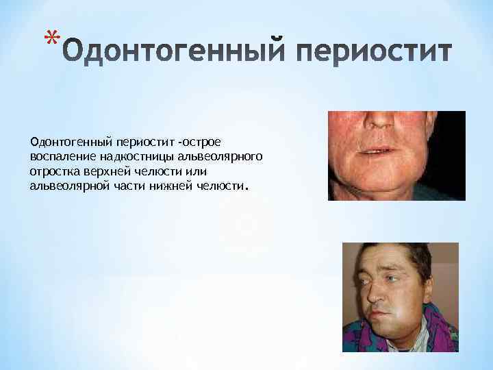 * Одонтогенный периостит -острое воспаление надкостницы альвеолярного отростка верхней челюсти или альвеолярной части нижней