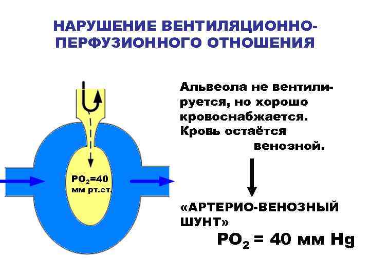 НАРУШЕНИЕ ВЕНТИЛЯЦИОННОПЕРФУЗИОННОГО ОТНОШЕНИЯ Альвеола не вентилируется, но хорошо кровоснабжается. Кровь остаётся венозной. РО 2=40