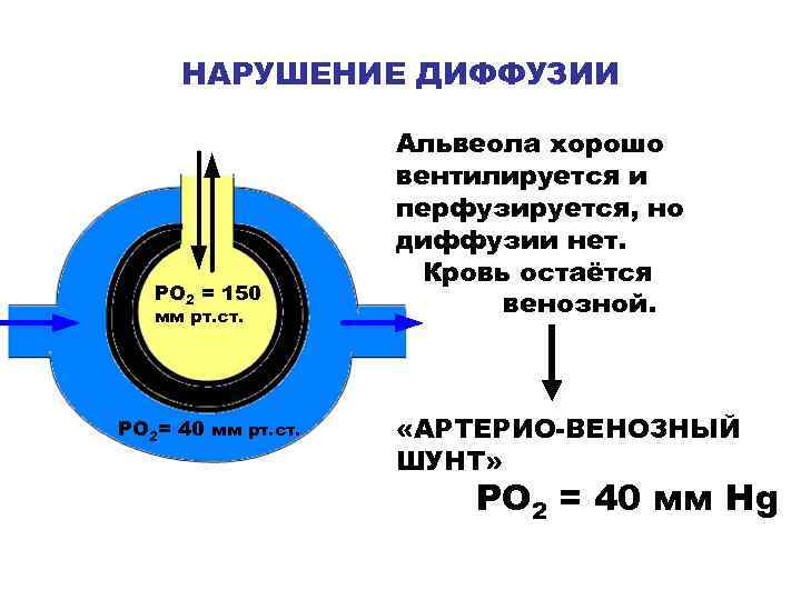 НАРУШЕНИЕ ДИФФУЗИИ РО 2 = 150 мм рт. ст. РО 2= 40 мм рт.