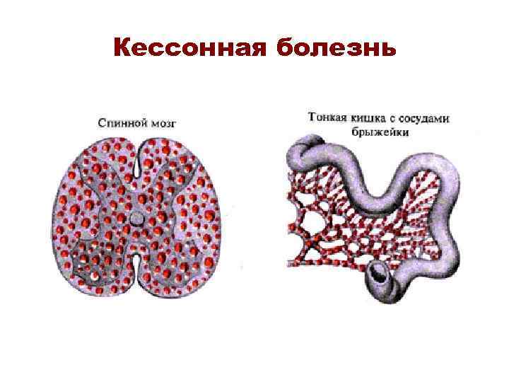 Кессонная болезнь 
