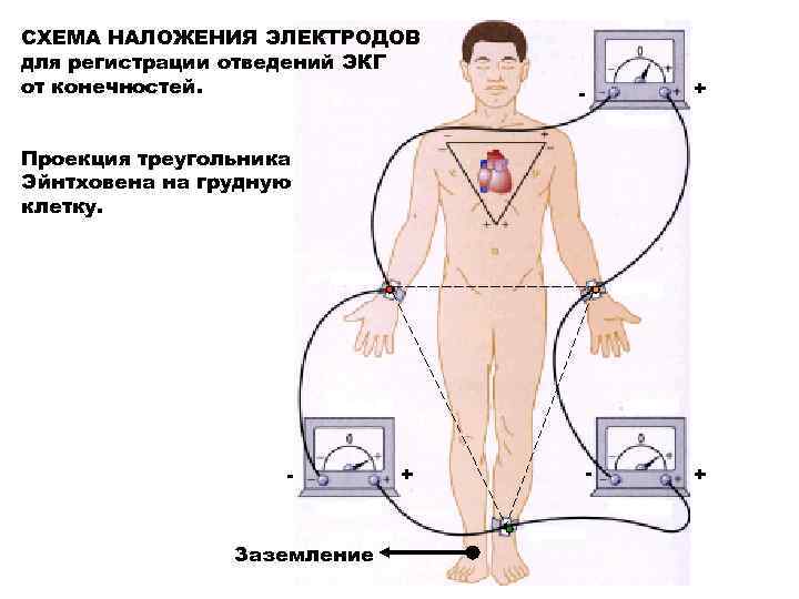 СХЕМА НАЛОЖЕНИЯ ЭЛЕКТРОДОВ для регистрации отведений ЭКГ от конечностей. + - Проекция треугольника Эйнтховена