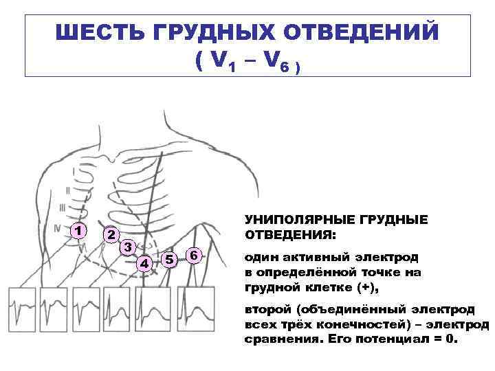 ШЕСТЬ ГРУДНЫХ ОТВЕДЕНИЙ ( V 1 – V 6 ) 1 2 3 УНИПОЛЯРНЫЕ