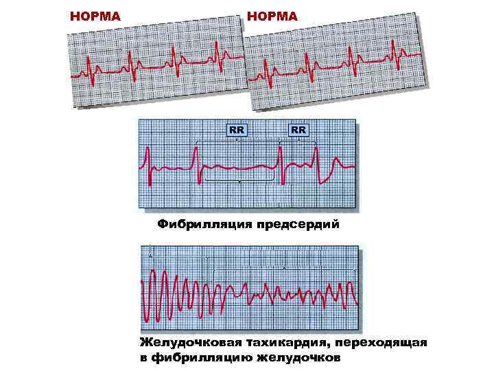 НОРМА Ecg RR RR Фибрилляция предсердий Желудочковая тахикардия, переходящая в фибрилляцию желудочков 