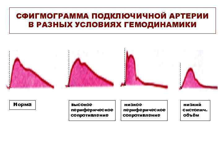 СФИГМОГРАММА ПОДКЛЮЧИЧНОЙ АРТЕРИИ В РАЗНЫХ УСЛОВИЯХ ГЕМОДИНАМИКИ Норма высокое периферическое сопротивление низкий систолич. объём