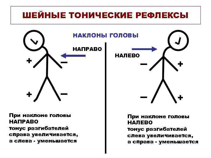 ШЕЙНЫЕ ТОНИЧЕСКИЕ РЕФЛЕКСЫ НАКЛОНЫ ГОЛОВЫ НАПРАВО + + При наклоне головы НАПРАВО тонус разгибателей