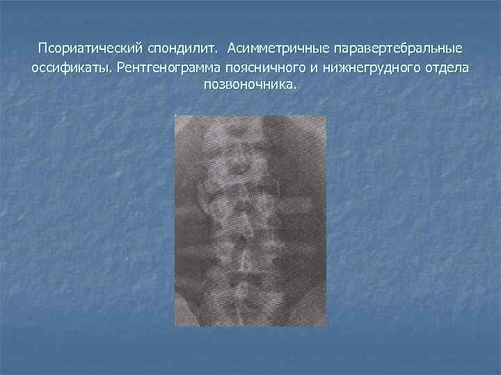 Псориатический спондилит. Асимметричные паравертебральные оссификаты. Рентгенограмма поясничного и нижнегрудного отдела позвоночника. 