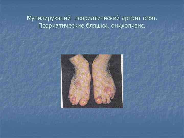 Мутилирующий псориатический артрит стоп. Псориатические бляшки, онихолизис. 