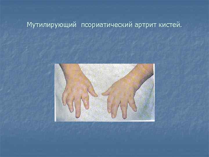 Мутилирующий псориатический артрит кистей. 