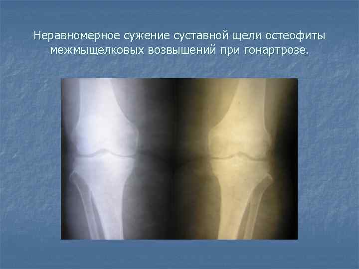 Неравномерное сужение суставной щели остеофиты межмыщелковых возвышений при гонартрозе. 