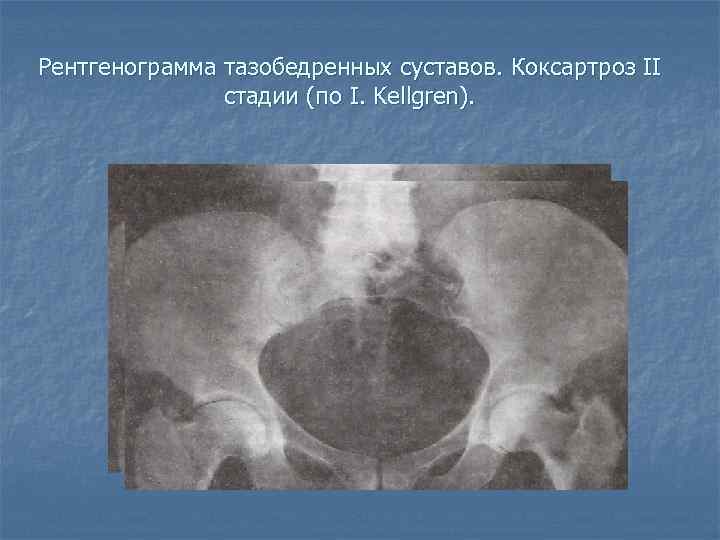 2 степень тазобедренных суставов. Коксартроз 2 степени рентген. Коксартроз тазобедренного сустава рентген. Кт деформирующий коксартроз. Коксартроз степени рентген.