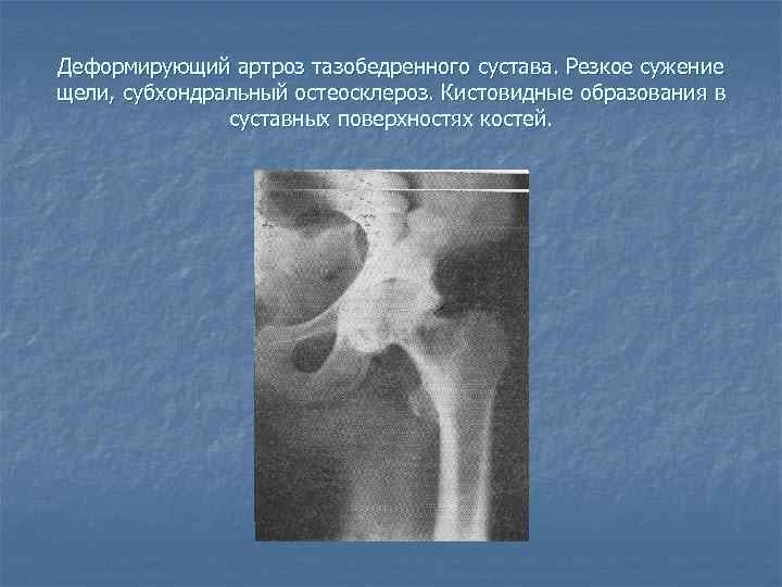 Двусторонний деформирующий