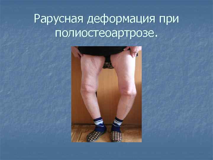 Рарусная деформация при полиостеоартрозе. 
