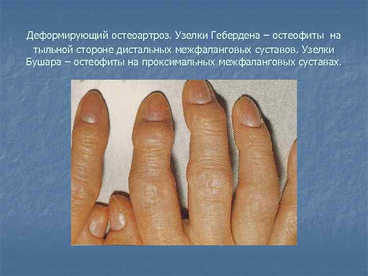 Деформирующий остеоартроз. Узелки Гебердена – остеофиты на тыльной стороне дистальных межфаланговых суставов. Узелки Бушара