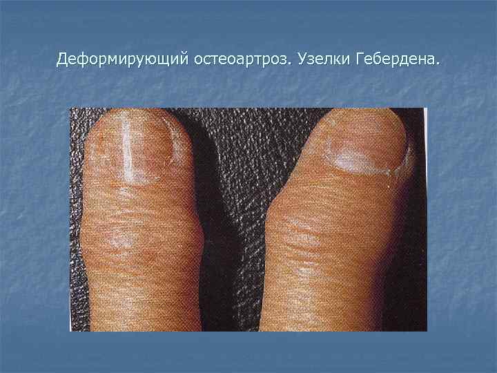 Деформирующий остеоартроз. Узелки Гебердена. 