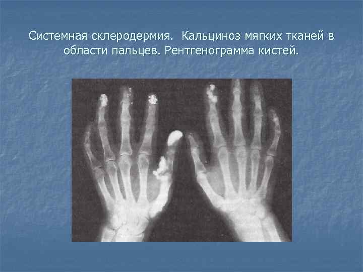 Системная склеродермия. Кальциноз мягких тканей в области пальцев. Рентгенограмма кистей. 